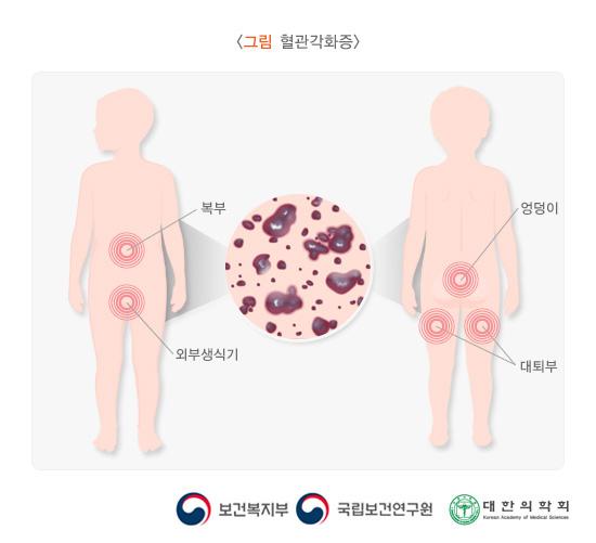 혈관각화증