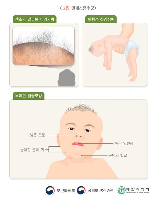 멘케스증후군