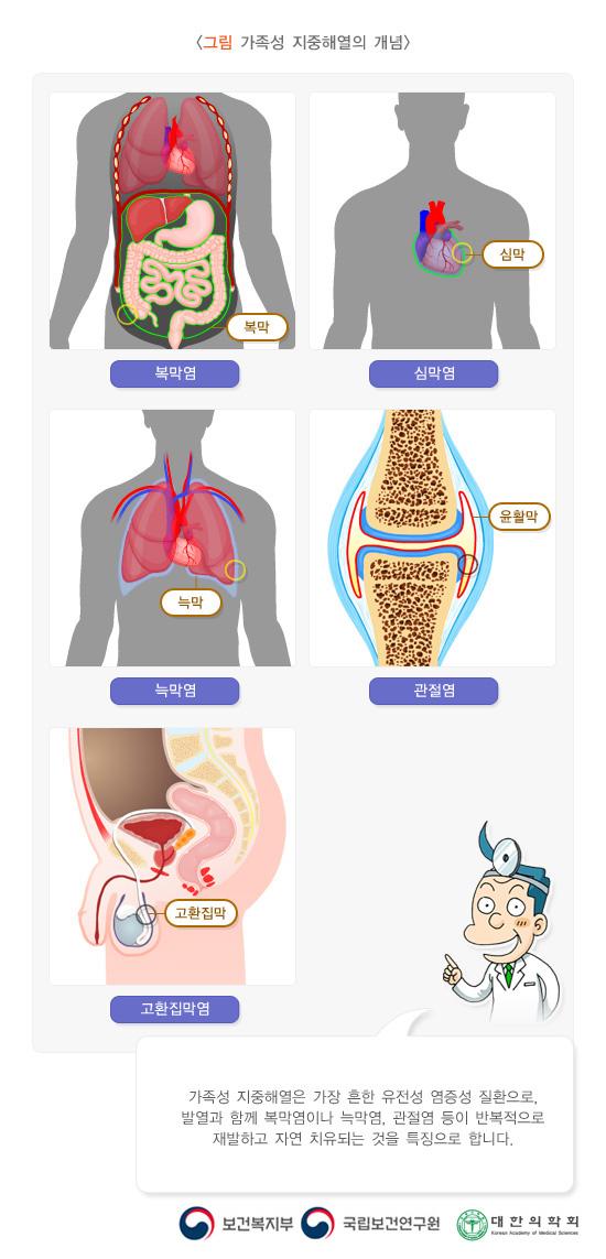 가족성 지중해열의 개념. 복막염(복막), 심막염(심막), 늑막염(늑막), 관절염(윤활막), 고환집막염(고환집막). 가족성 지중해열은 가장 흔한 유전성 염증성 질환으로, 발열과 함께 복막염이나 늑막염, 관절염 등이 반복적으로 재발하고 자연 치유되는 것을 특징으로 합니다. 보건복지부, 국립보건연구원, 대한의학회
