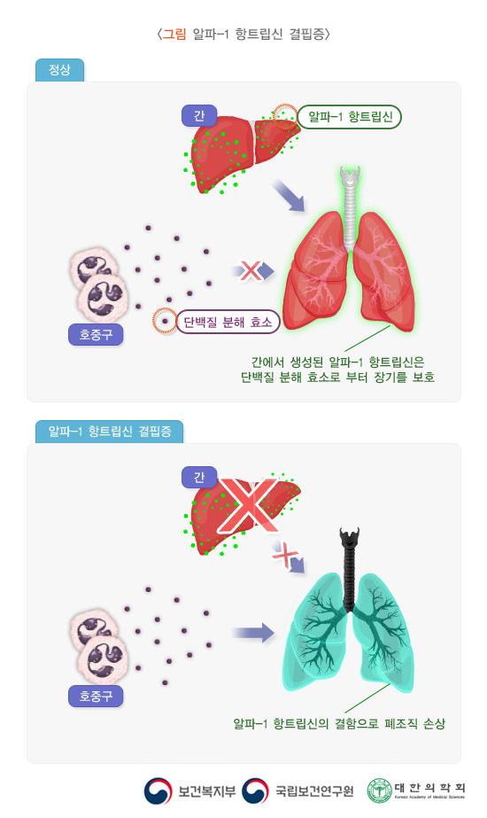 그림 알파-1 항트립신 결핍증. 정상. 간. 알파-1 항트립신. 호중구> 단백질 분해효소. 간에서 생성된 알파-1 항트립신은 단백질 분해 효소로부터 장기를 보호. 알파-1 항트립신 결핍증. 간에서 알파-1 항트립신 결핍. 호중구의 단백질 분해 효소의 영향과 알파-1 항트립신의 결함으로 폐조직 손상. 보건복지부, 국립보건연구원, 대한의학회