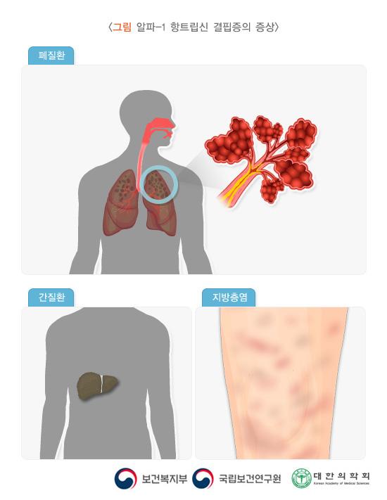 알파-1 항트립신 결핍증의 증상. 폐질환, 간질환, 지방층염. 보건복지부, 국립보건연구원, 대한의학회