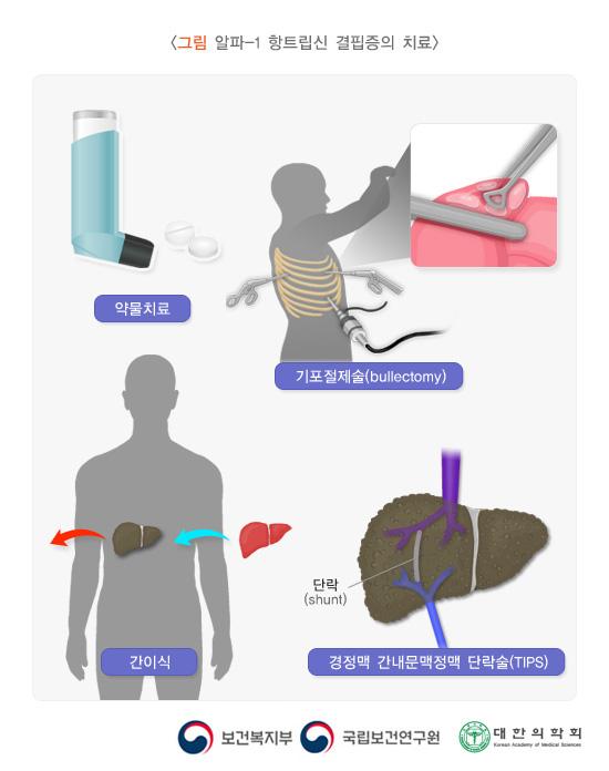 알파-1 항트립신 결핍증의 치료. 약물치료, 기포절제술(bullectomy), 간이식, 경정맥 간내문맥정맥 단락술(TIPS). 단락(shunt). 보건복지부, 국립보견연구원, 대한의학회
