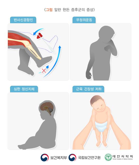 알란 헌든 증후군의 증상: 반사신경항진, 무정위운동, 심한 정신지체, 근육 긴장성 저하