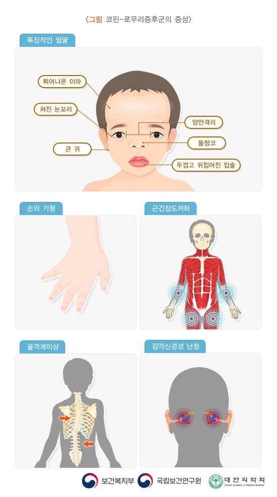 코핀-로우리증후군의 증상: 튀어나온 이마, 쳐진 눈꼬리, 양안격리, 큰 귀, 들창코, 두껍고 뒤집어진 입술의 얼굴과 손의 기형, 근긴장도저하, 골격계이상, 감각신경성 난청