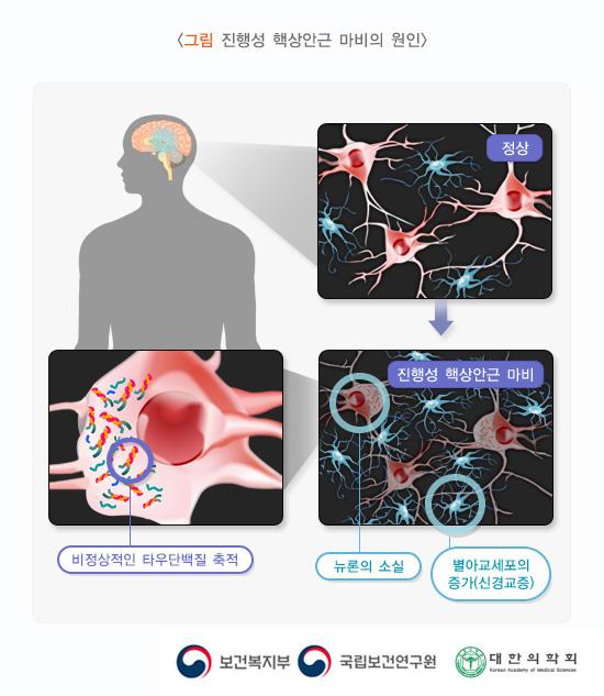 진행성 핵상안근 마비의 원인