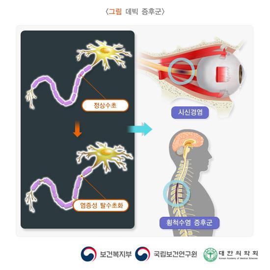 데빅 증후군