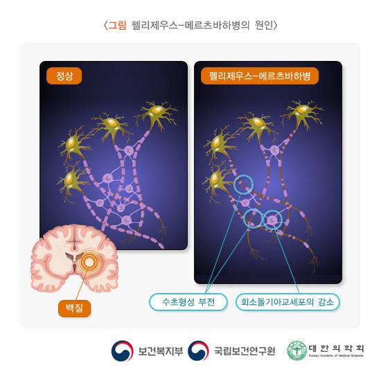 펠리제우스-메르츠바하병의 원인