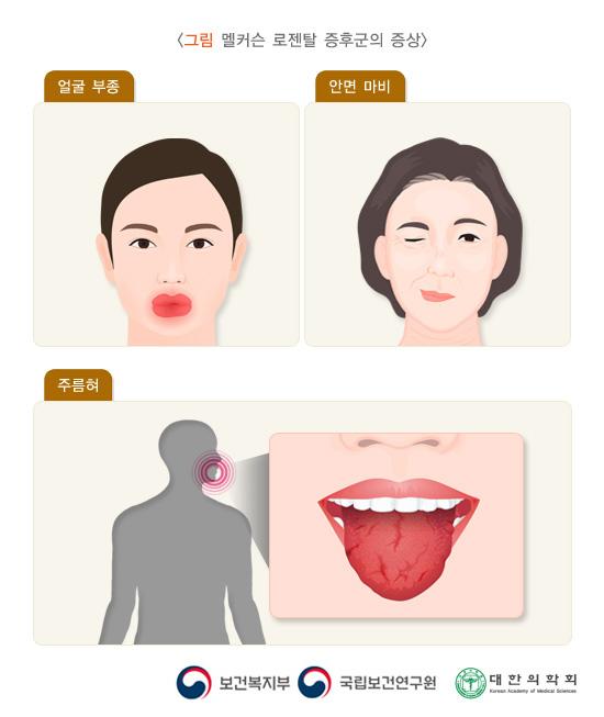 멜커슨 로젠탈 증후군의 증상