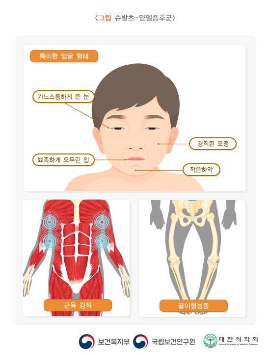 슈발츠-얌펠증후군