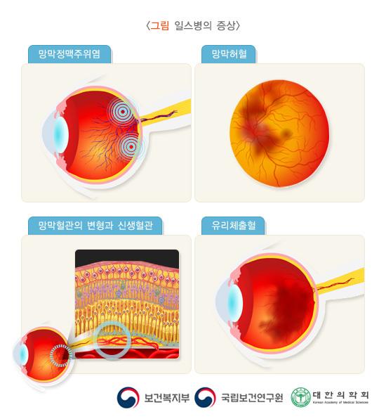 일스병의 증상 그림. 망망정맥주위염, 망망허혈, 망막혈관의 변형과 신생혈관, 유리체출혈. 보건복지부, 국립보건연구원, 대한의학회