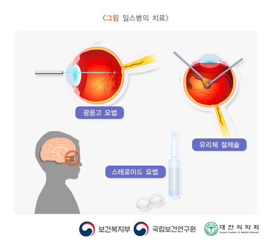 일스병의 치료 방법 그림. 광응고 요법, 유리체 절제술, 스테로이드 요법. 보건복지부, 국립보건연구원, 대한의학회