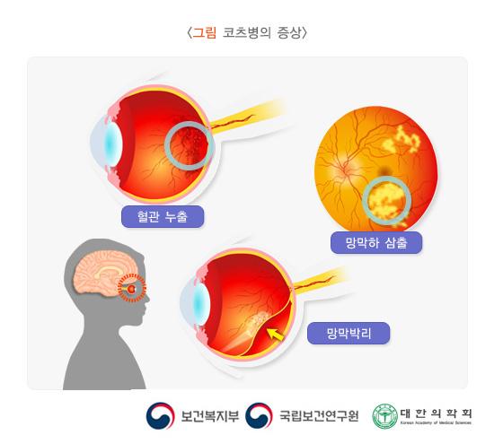 코츠병의 증상 그림. 혈관누출, 망막하 삼출, 망막박리. 보건복지부, 국립보건연구원, 대한의학회