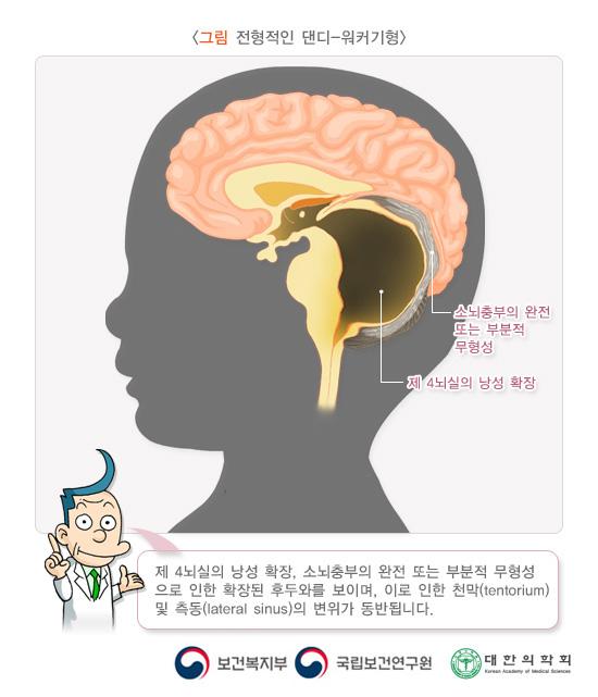 전형적인 댄디-워커기형