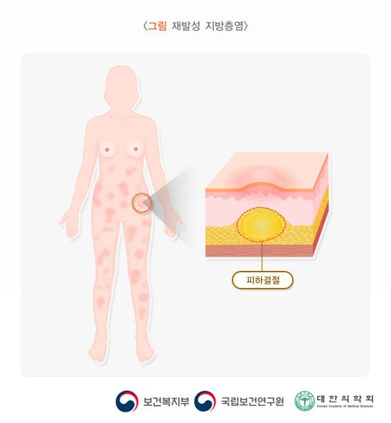 재발성 지방층염의 피하결절 확대 그림입니다. 보건복지부, 국립보건연구원, 대한의학회.