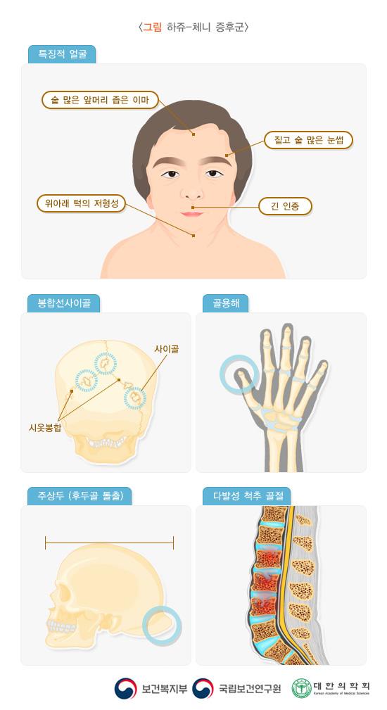 하쥬-체니 증후군 특징 그림: 숱 많은 앞머리 좁은 이마, 짙고 숱 많은 눈썹, 위아래 턱의 저형성, 긴 인중의 특징적 얼굴과 봉합선사이골, 골용해, 주상두(후두골 돌출), 다발성 척추 골절