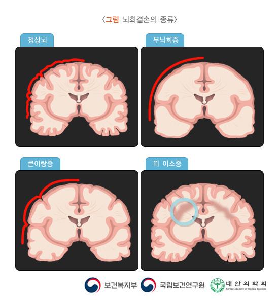 뇌회결손의 종류