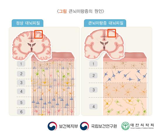큰뇌이랑증의 원인