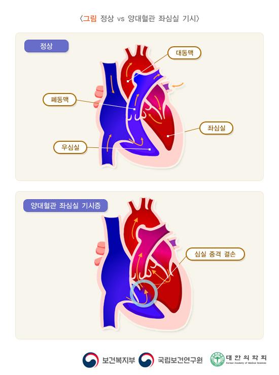 정상 vs 양대혈관 좌심실 기시