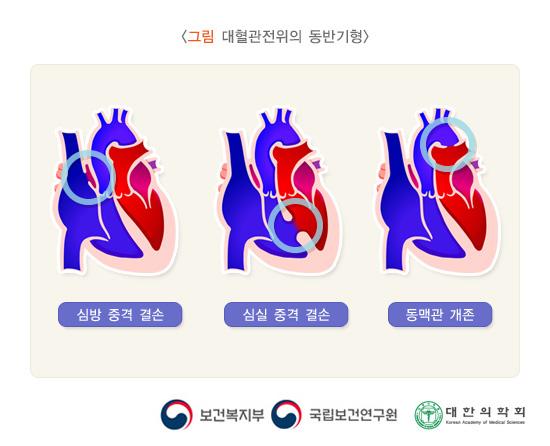 대혈관전위의 동반기형