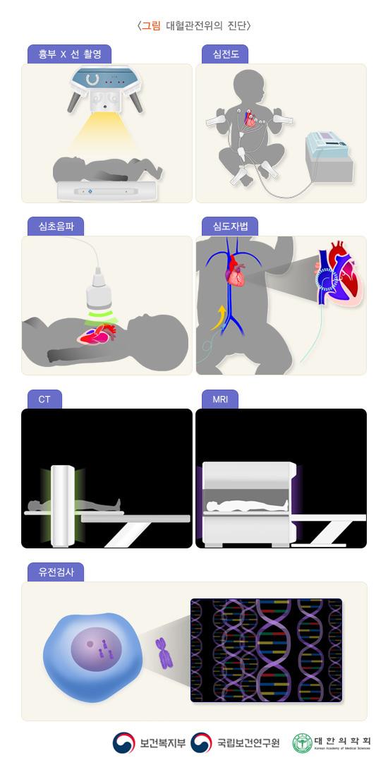 대혈관전위의 진단