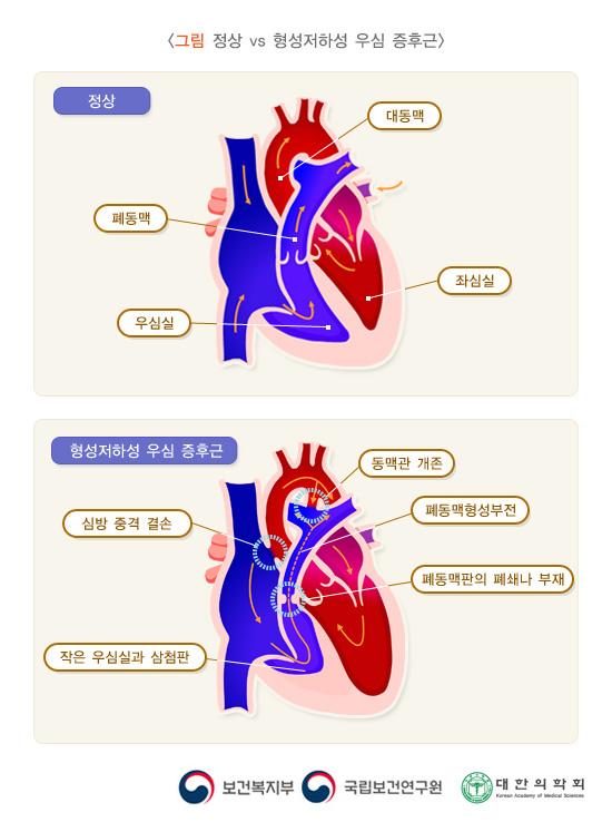 정상 vs 형성저하성 우심 증후군