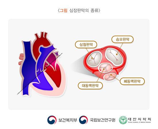 심장판막의 종류