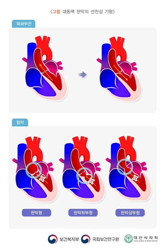 대동맥 판막의 선천성 기형