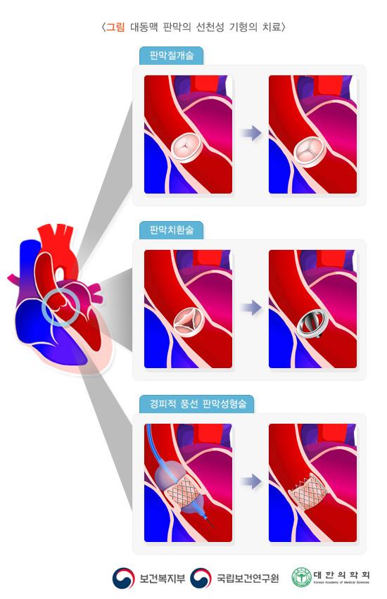 대동맥 판막의 선천성 기형의 치료