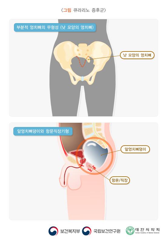 큐라리노 증후군 특징적 그림: 부분적 엉치뼈의 무형성(낫 모양의 엉치뼈), 앞엉치뼈덩이와 항문직장기형