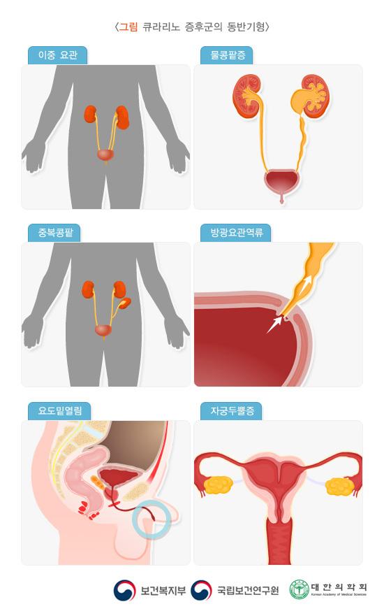 큐라리노 증후군의 동반기형 증상: 이중 요관, 물콩팥증, 중복콩팥, 방광요관역류, 요도밑열림, 자궁두뿔증