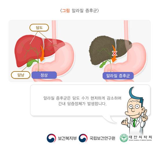 알라질 증후군