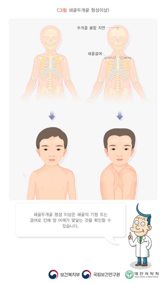 쇄골두개골 형성이상