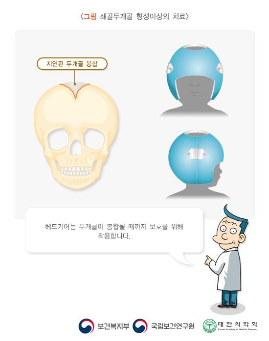 쇄골두개골 형성이상의 치료 