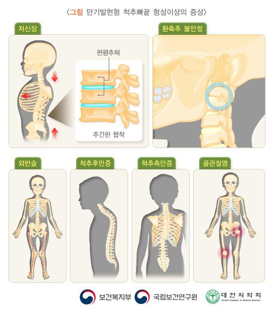 만기발현형 척추뼈끝 형성이상