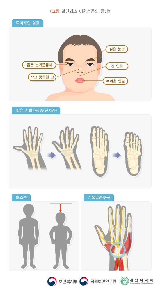 말단왜소 이형성증의 증상