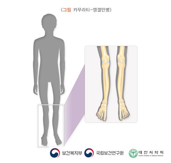 카무라티-엥겔만병