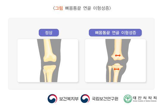 카무라티-엥겔만병