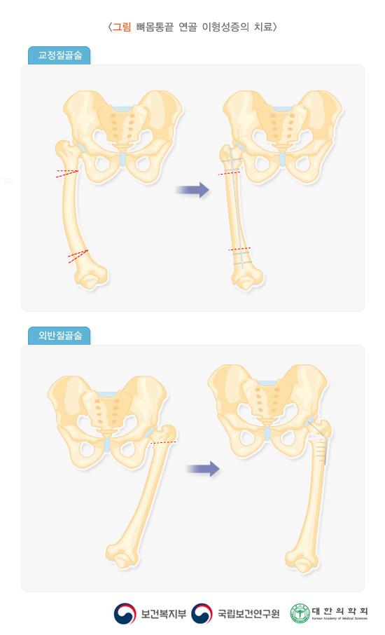 뼈몸통끝 연골 이형성증의 치료