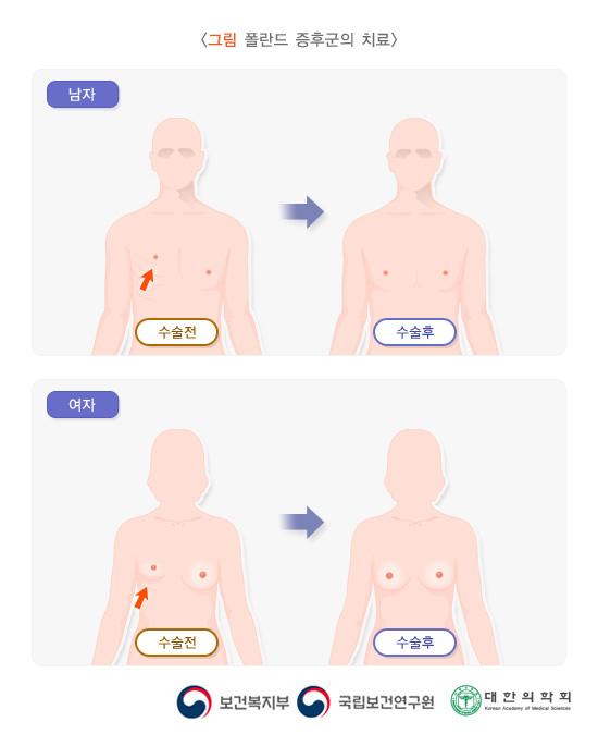 폴란드증후군의 치료