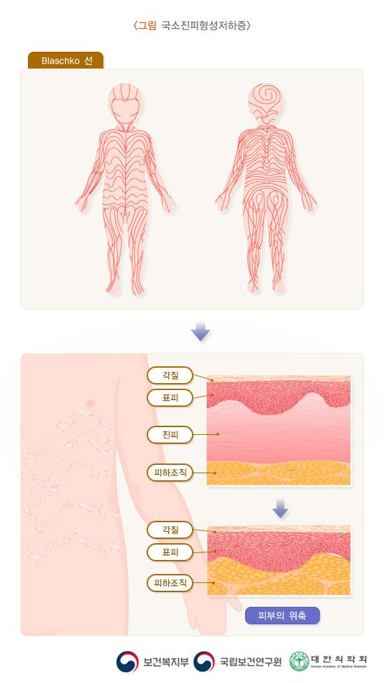 국소진피형성저하증의 Blaschko 선 그림. 각질, 표피, 진피, 피하조직으로 이루어진 피부가 각질, 표피, 피하조직으로 위축된 그림