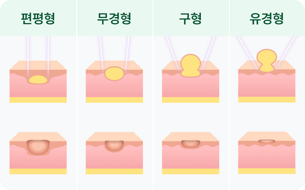 피부 신경섬유종 치료, 신경섬유종증 1형 치료, CO2 레이저