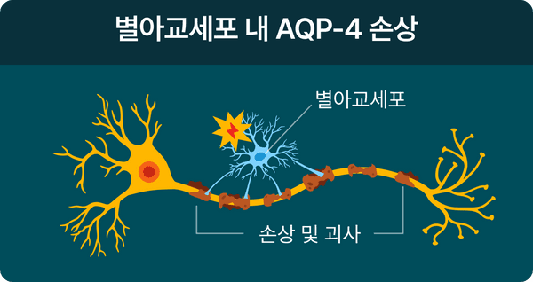 별아교세포 내 AQP-4손상