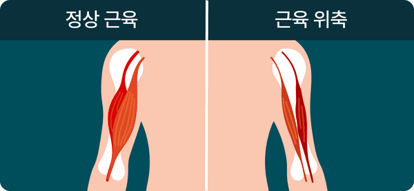 근육 위축