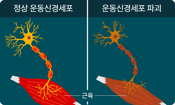 운동신경세포 파괴