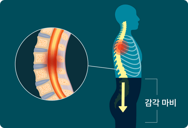 감각 마비