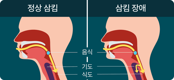 삼킴 장애