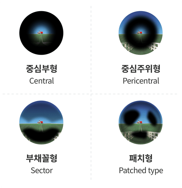 중심부형, 중심주위형, 부채꼴형, 패치형