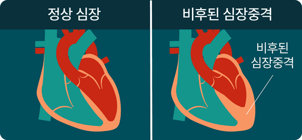 비후된 심장중격