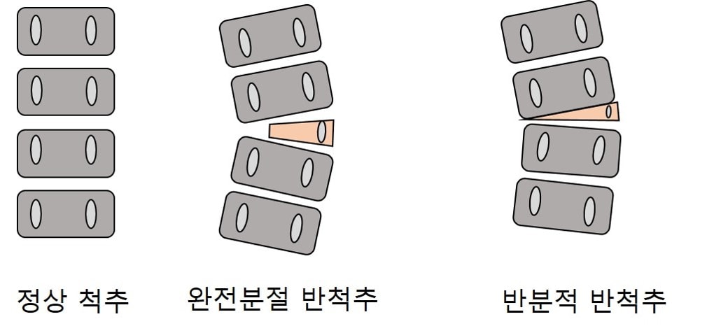 정상척추와 비교 그림