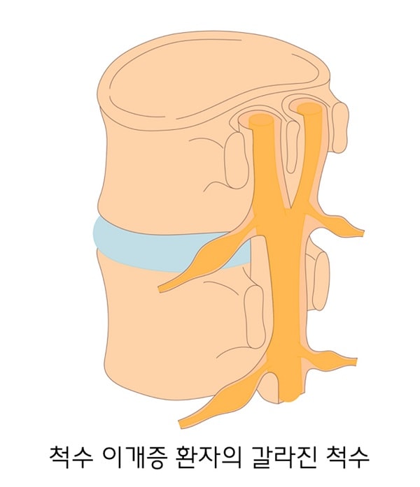 척수 이개증 환자의 갈라진 척수 그림